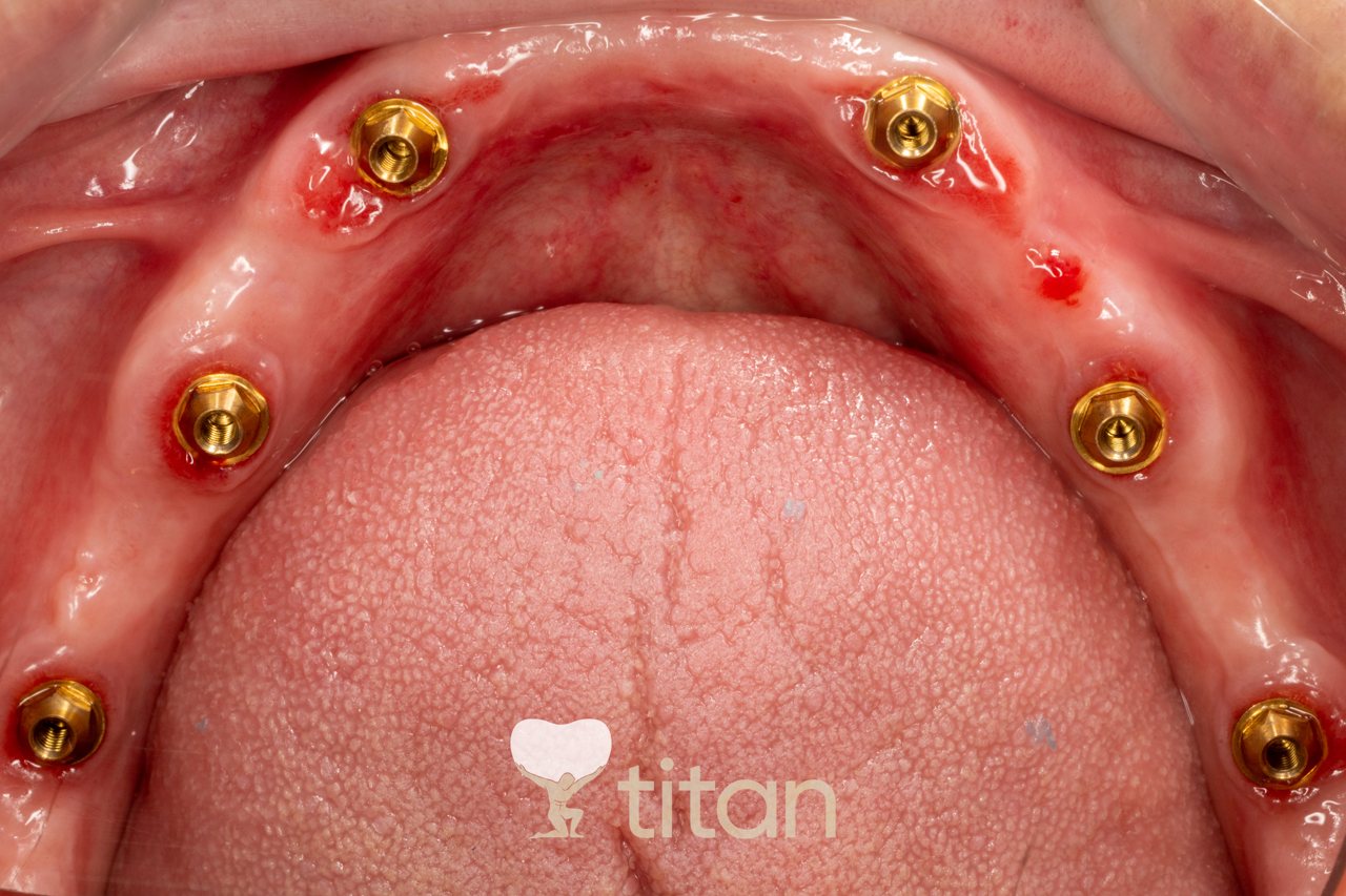 Установленные импланты Dentium
